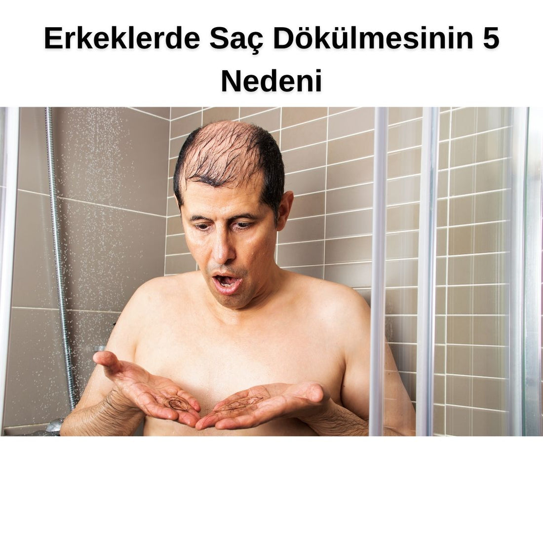 Erkeklerde Saç Dökülmesi: Nedenleri ve Çözüm Önerileri - HAİR MEDİCAL SHOP